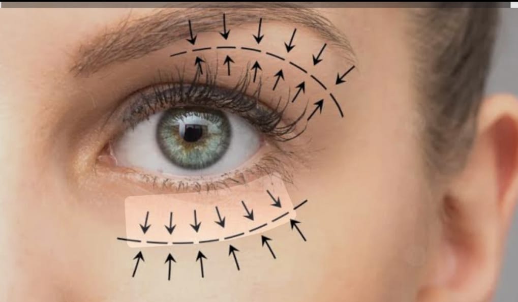 تجميل الأجفان